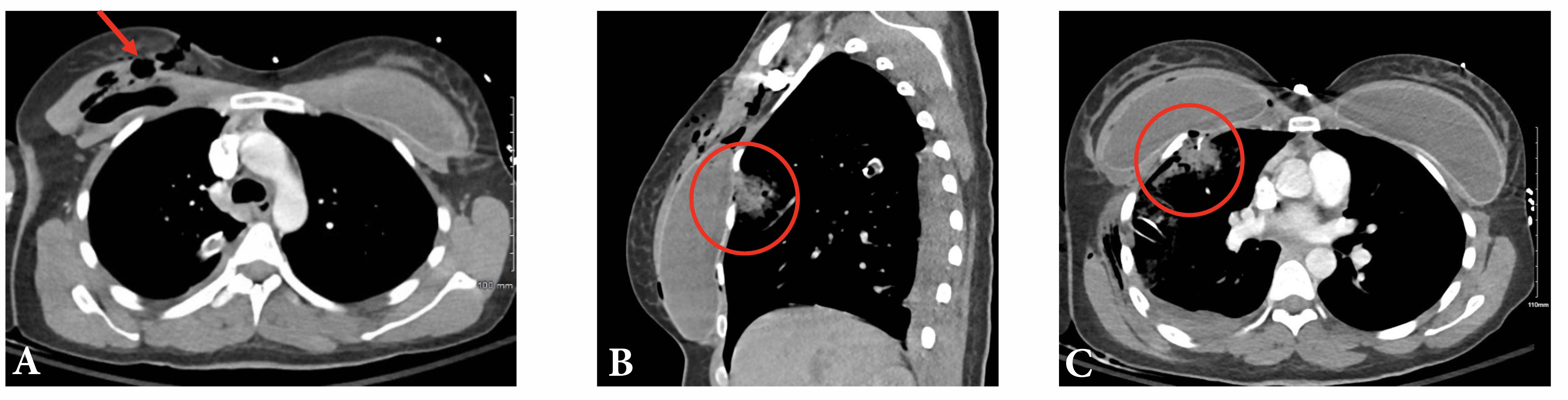 Breast Implants Save Lives Gunshot Wound to a Silicone Gel Implant